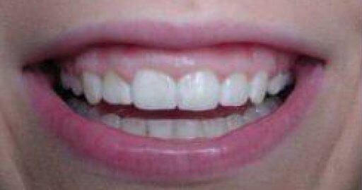 teeth needing endodontic services