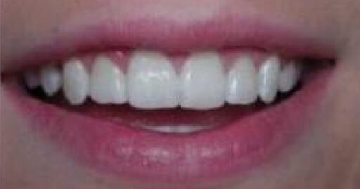 smile of whitened teeth