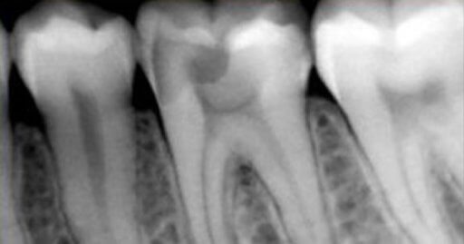xrays of molars