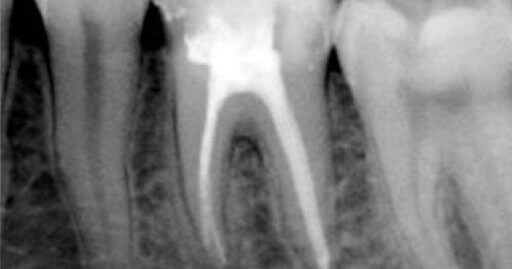 xray of tooth roots