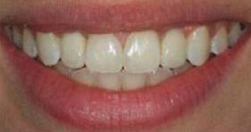smile of straightened teeth