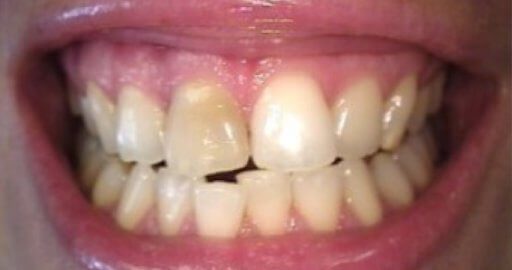 smile showing stained and crooked teeth