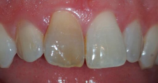 stained front teeth