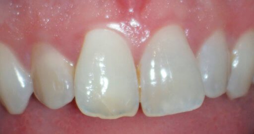 close up of teeth needing repair